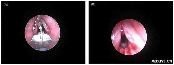    图1. 采用鳄口钳移除喉部异物(A)，紧接着的图像显示声门前后的炎症和肉芽组织(B)。